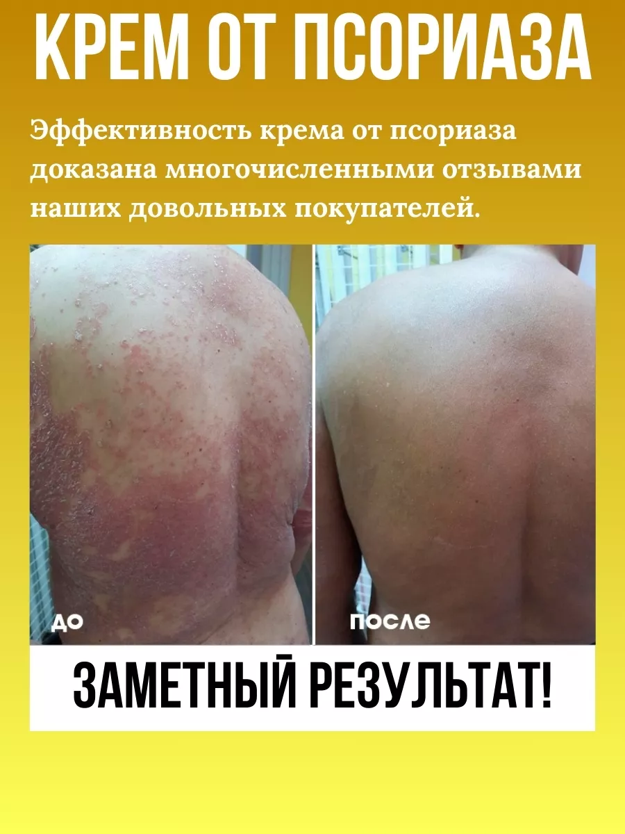 Крем Рецепт №12 ОТ ПСОРИАЗА с чистотелом и березовым дегтем, 100 мл.-7