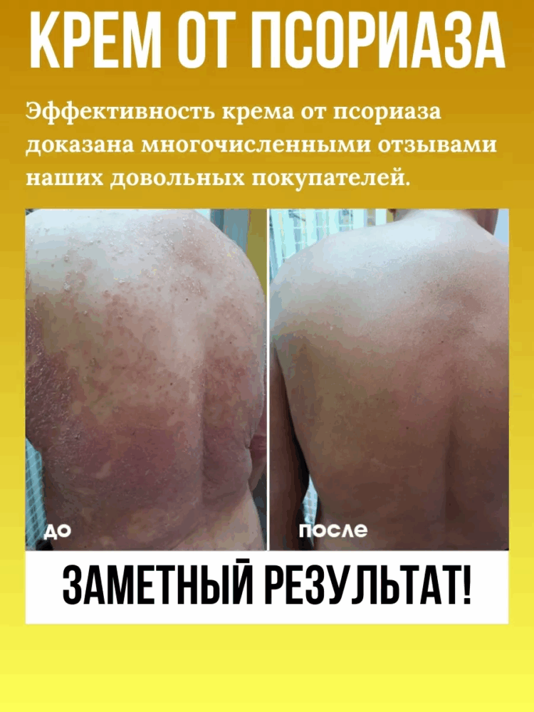 Крем Рецепт №12 ОТ ПСОРИАЗА с чистотелом и березовым дегтем, 100 мл.-21